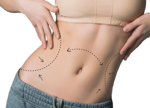 Aspectos debo de considerar antes de realizarme una Abdominoplastia