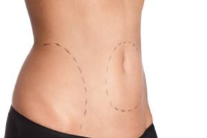 Aspectos debo de considerar antes de realizarme una Abdominoplastia