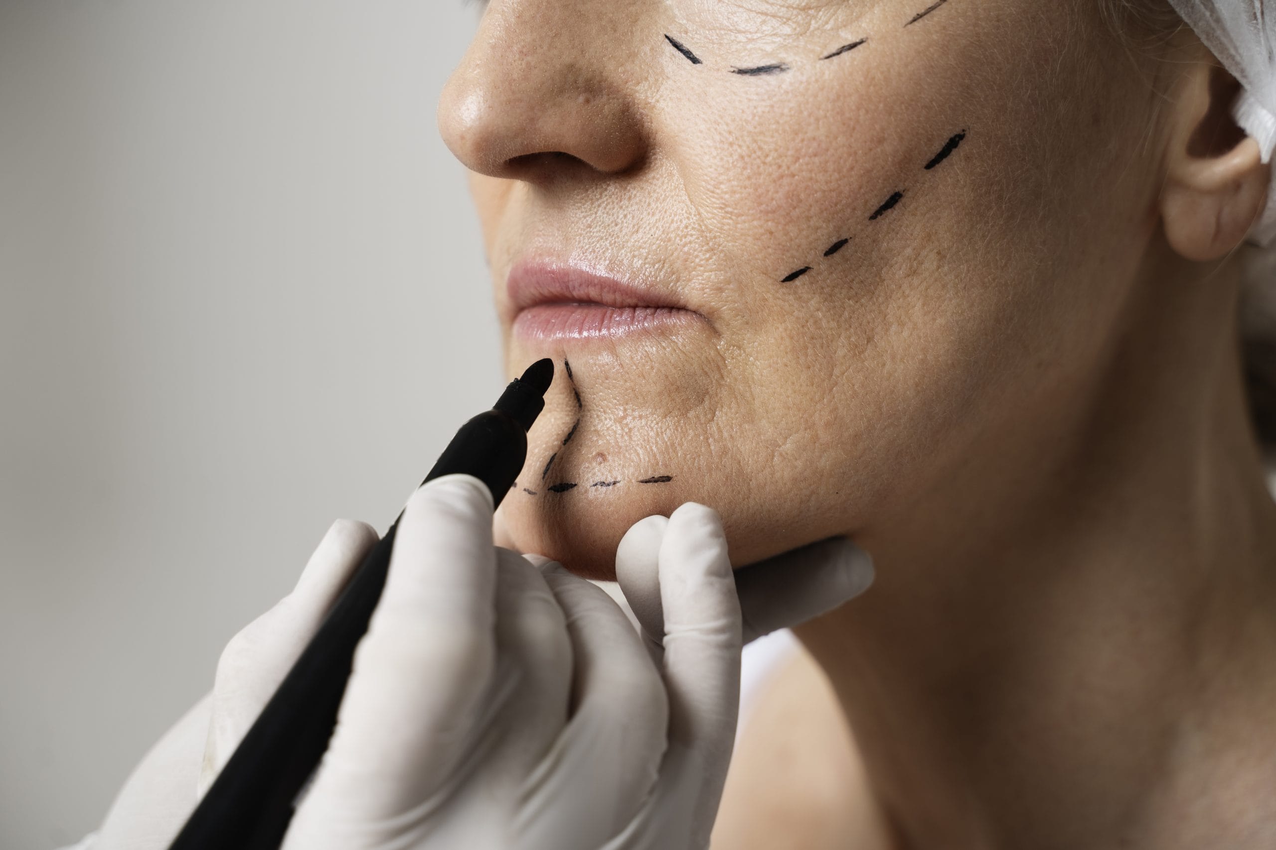 Riesgos comunes de la cirugía estética facial