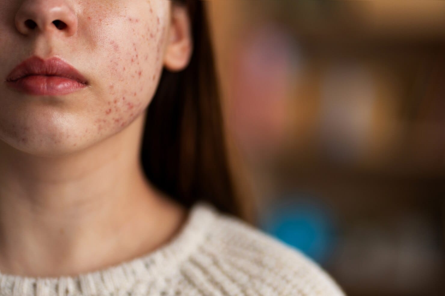 Tratamientos para Manchas Oscuras en la Piel